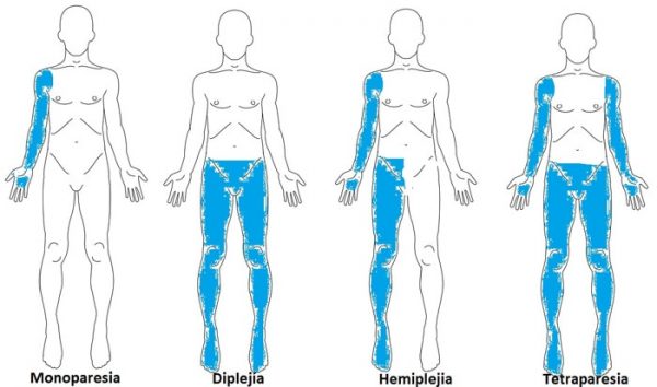 HEMIPLEJIA / HEMIPARESIA - Entremares Kids